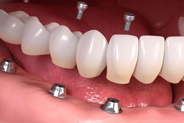 Всё на 4: Имплантация зубов виды и цены